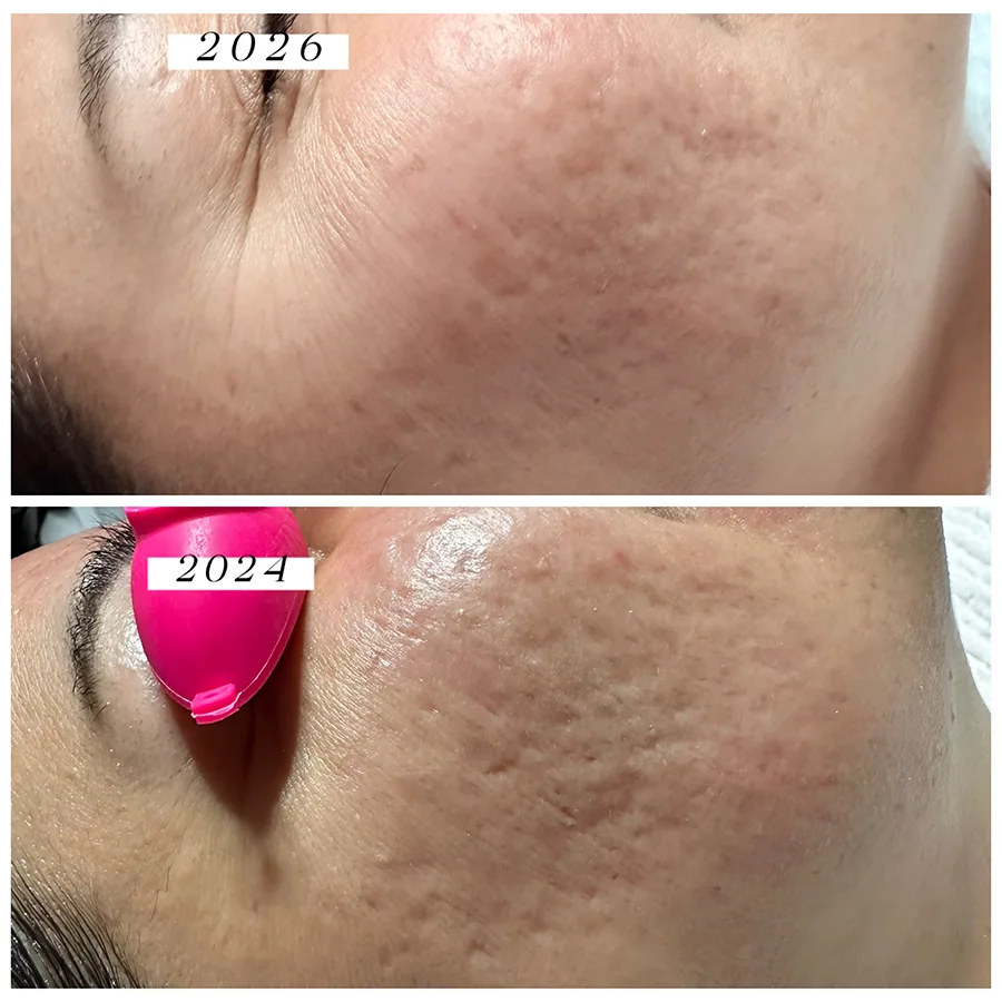 A customized acne-focused treatment that includes deep cleansing