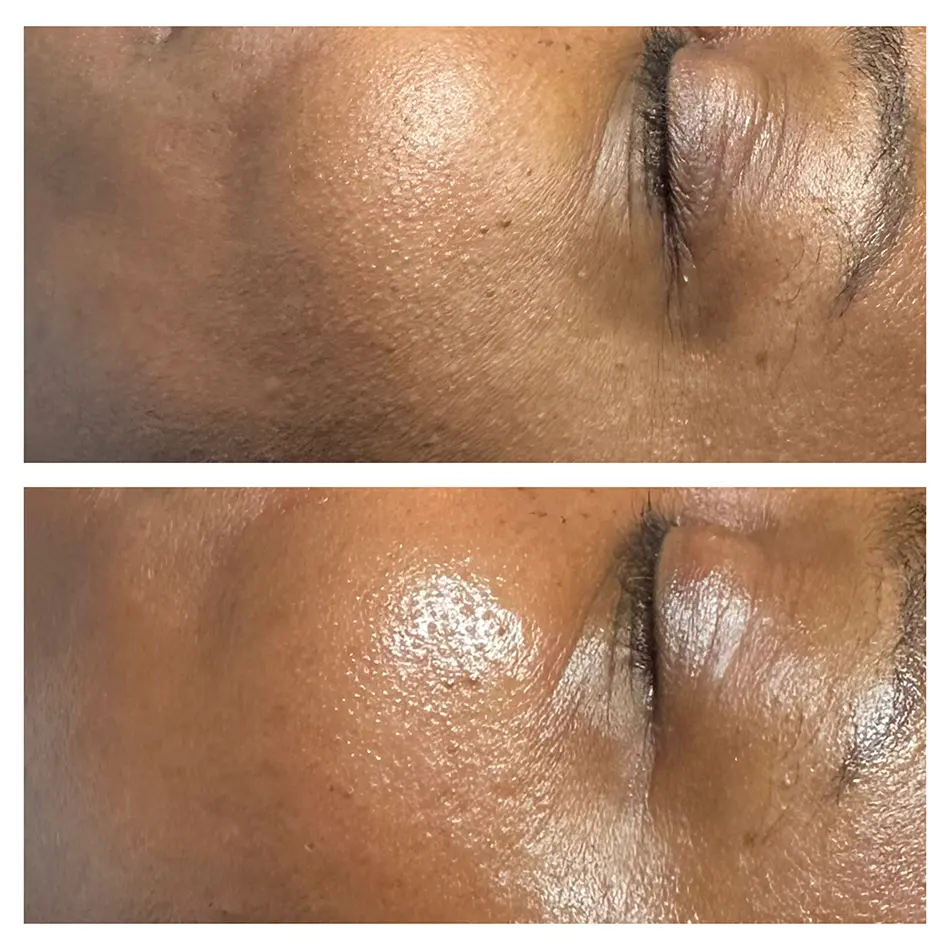 A professional anti aging facial in San Antonio designed to improve the appearance of fine lines, wrinkles, uneven texture, and dull skin.