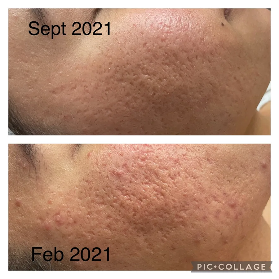 Microneedling in San Antonio